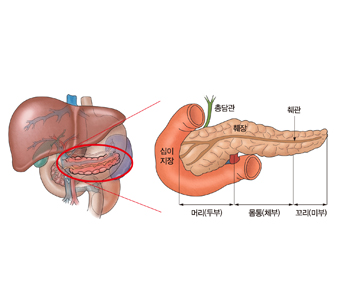 췌장암 원인