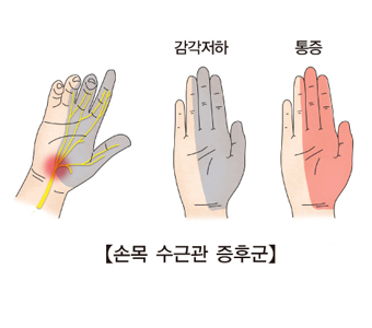 손목터널증후군 증상을 방치하면 수술까지 이어진다