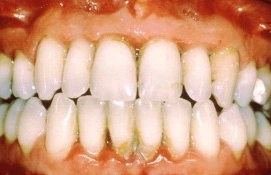잇몸 염증: 치은염&치주염 증상(잇몸 부었을 때, 아플때, 출혈, 간지러움, 시림, 치아흔들림 등)과 치과잇몸치료