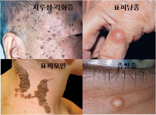 피부의 양성 종양 | 질환백과 | 의료정보 | 건강정보 | 서울아산병원
